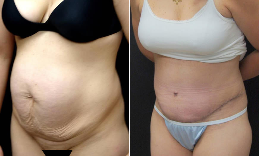 Before & After Tummy Tuck Quarter Left View