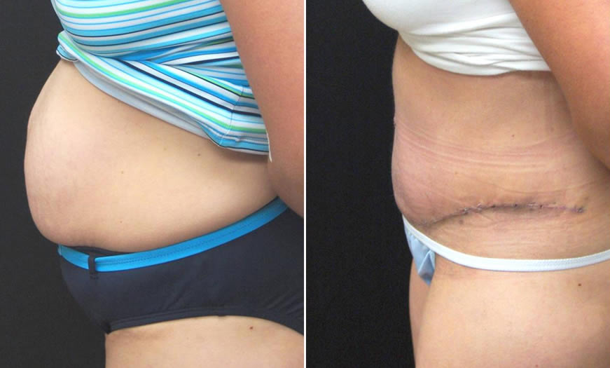Before & After Tummy Tuck Side Left View