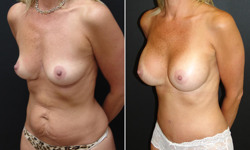 Before & After VASER LipoSelection Quarter Left View