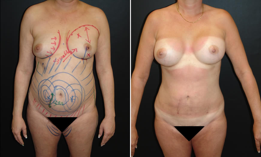 Before & After VASER LipoSelection Front View