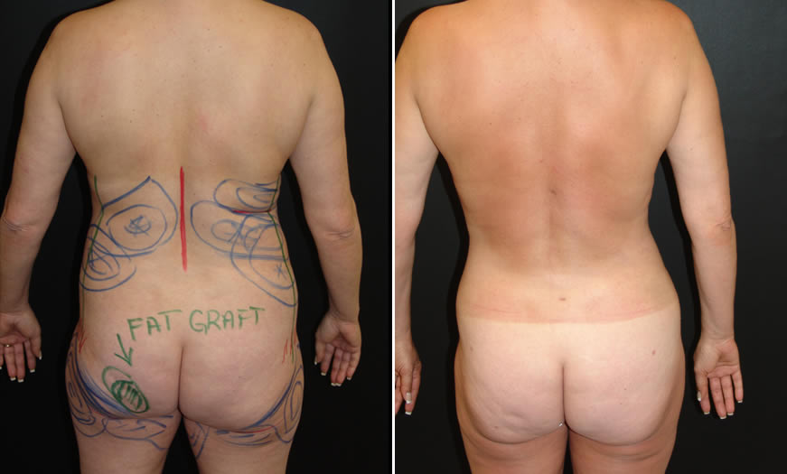 Before & After VASER LipoSelection Back View