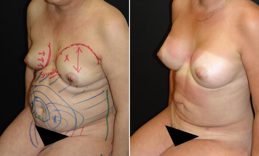 Before & After VASER LipoSelection Quarter Left Sitting View