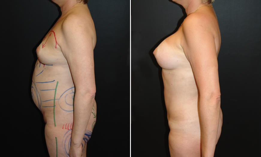 Before & After VASER LipoSelection Side Left View