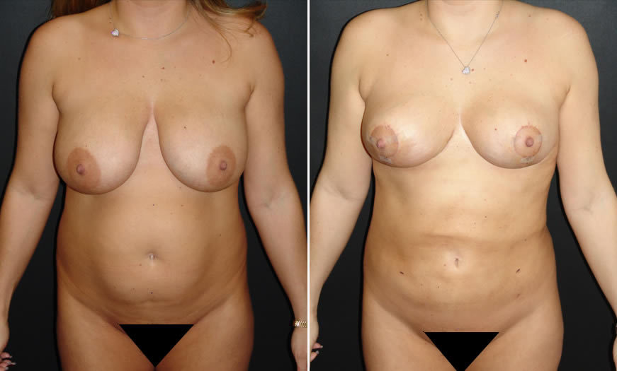 Before & After VASER LipoSelection Front View