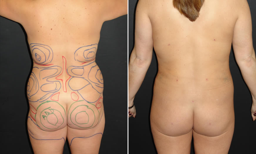 Before & After VASER LipoSelection Back View