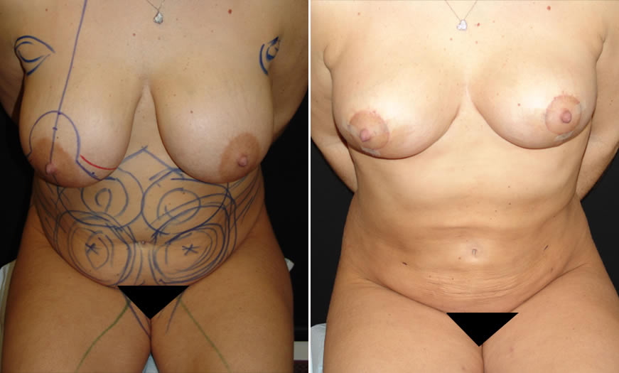 before & after VASER LipoSelection Front Sitting View