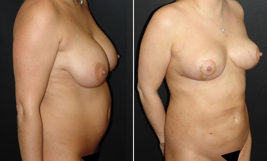 Before & After VASER LipoSelection Quarter Right View