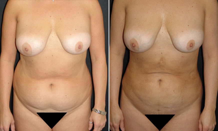 Before & After VASER LipoSelection Front View