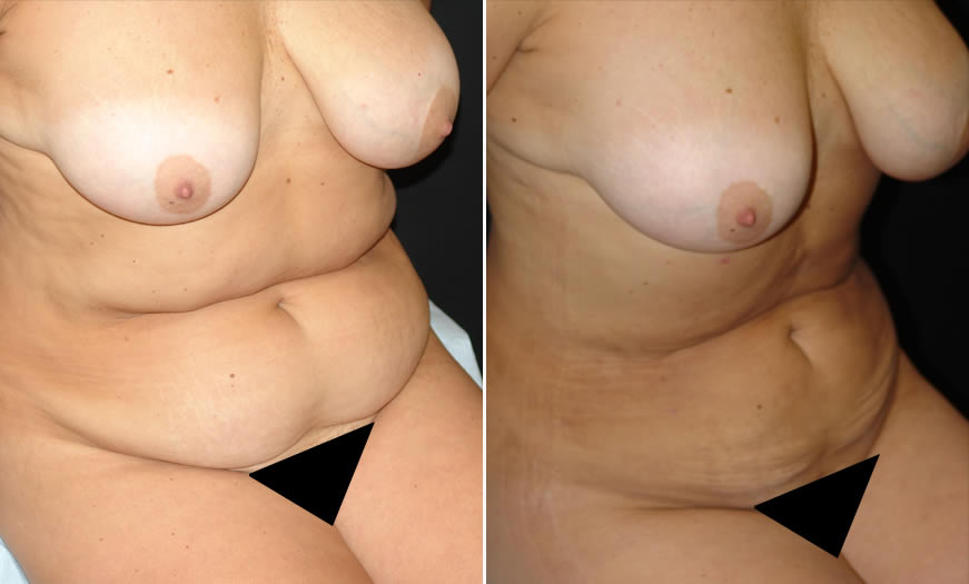 Before & After VASER LipoSelection Quarter Right Sitting View