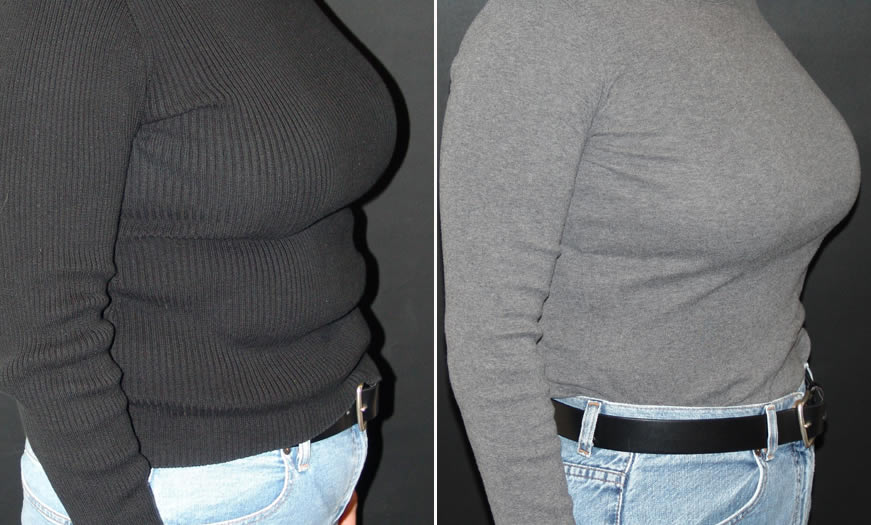 Before & After VASER LipoSelection Side Right View