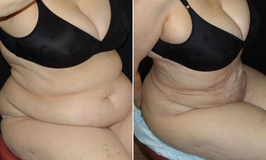 Before & After VASER LipoSelection Quarter Right Sitting View