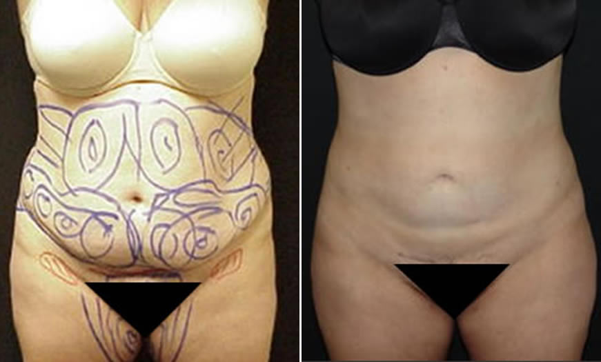 Before & After VASER LipoSelection Front View