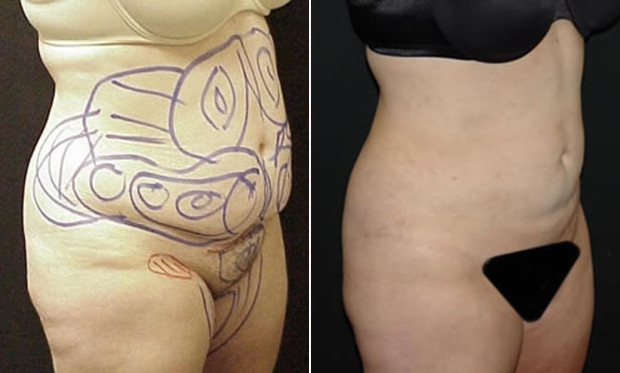 Before & After VASER LipoSelection Quarter Right View