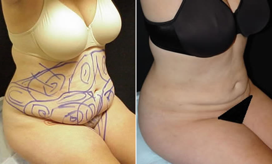 Before & After VASER LipoSelection Quarter Right Sitting View