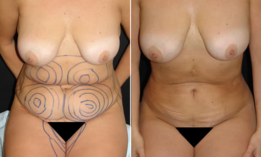 before & after VASER LipoSelection Front Sitting View