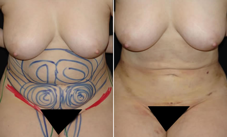 before & after VASER LipoSelection Front Sitting View