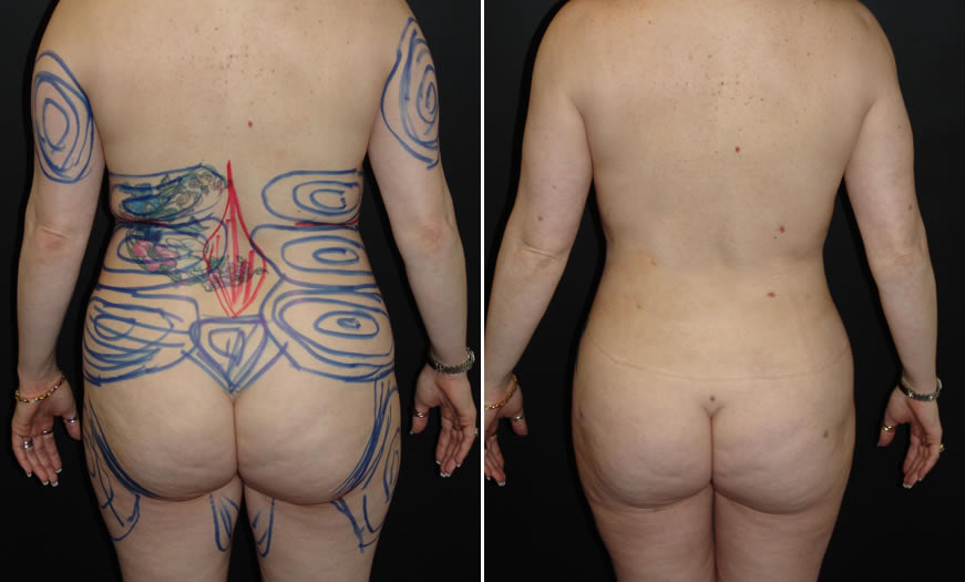 Before & After VASER LipoSelection Back View