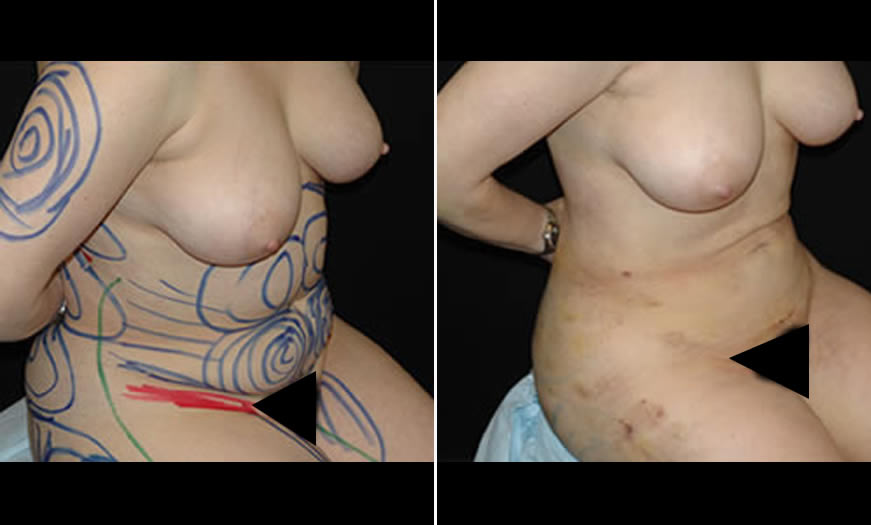 Before & After VASER LipoSelection Quarter Right Sitting View