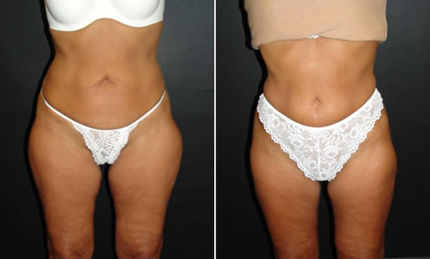 Before & After VASER LipoSelection Front View