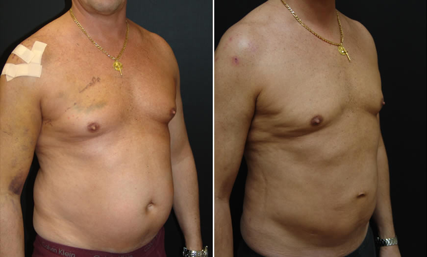 Before & After VASER LipoSelection Quarter Right View