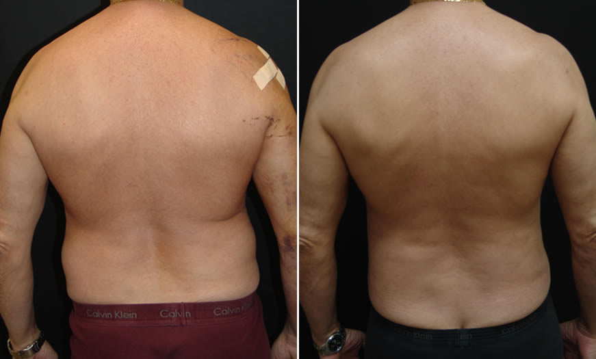 Before & After VASER LipoSelection Back View