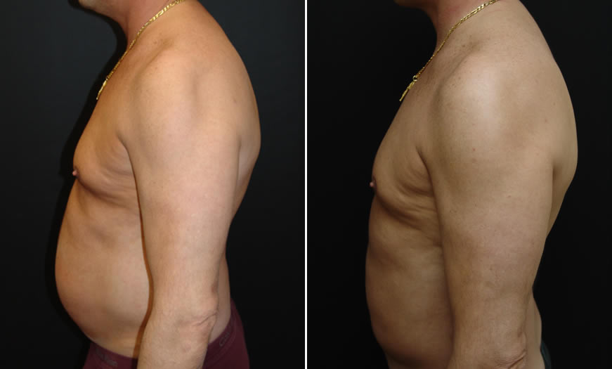 Before & After VASER LipoSelection Side Left View