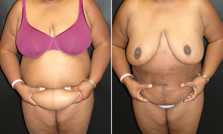 Before & After VASER LipoSelection Front View