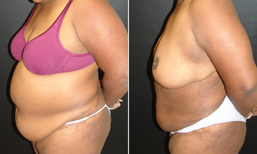 Before & After VASER LipoSelection Side Left View