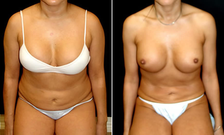 before & after VASER LipoSelection Front Sitting View