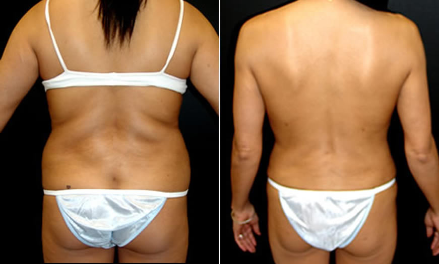 Before & After VASER LipoSelection Back View