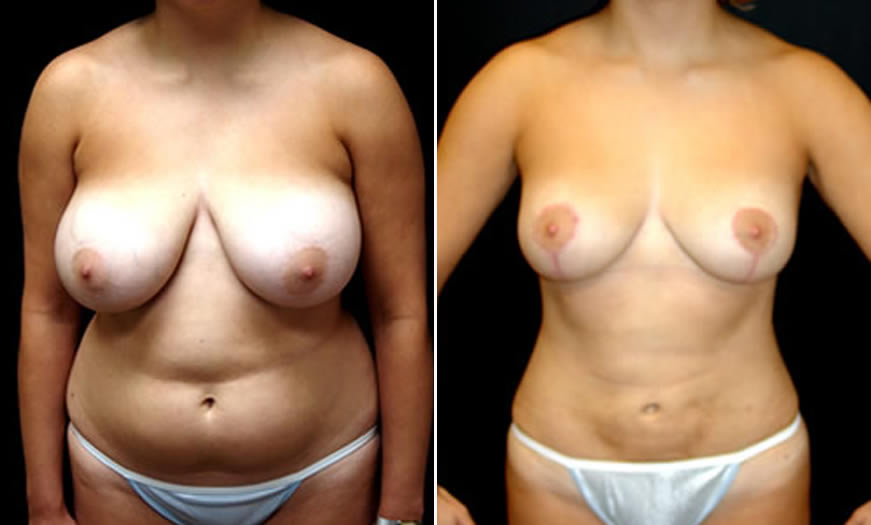 Before & After VASER LipoSelection Front View