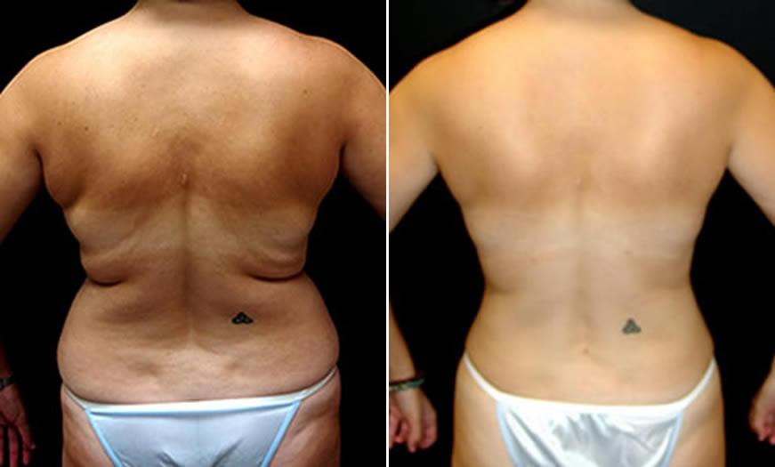 Before & After VASER LipoSelection Back View