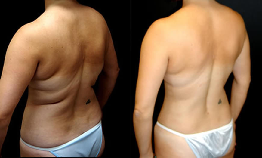 Before & After VASER LipoSelection Quarter Back Left View