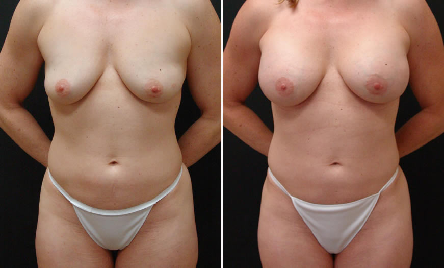 Before & After VASER LipoSelection Front View