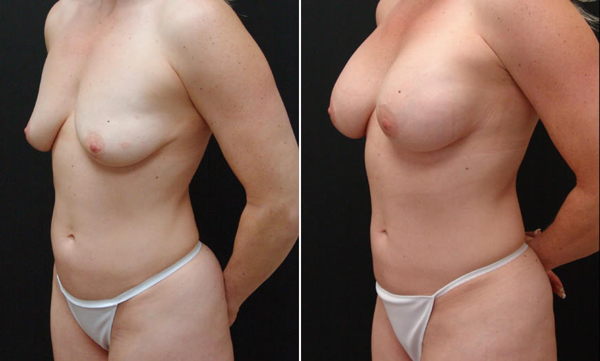 Before & After VASER LipoSelection Quarter Left View