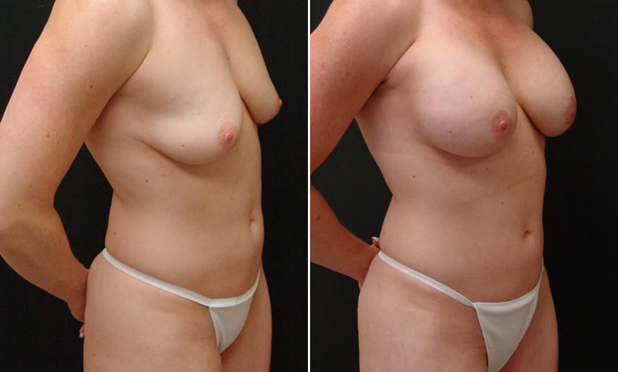 Before & After VASER LipoSelection Quarter Right View