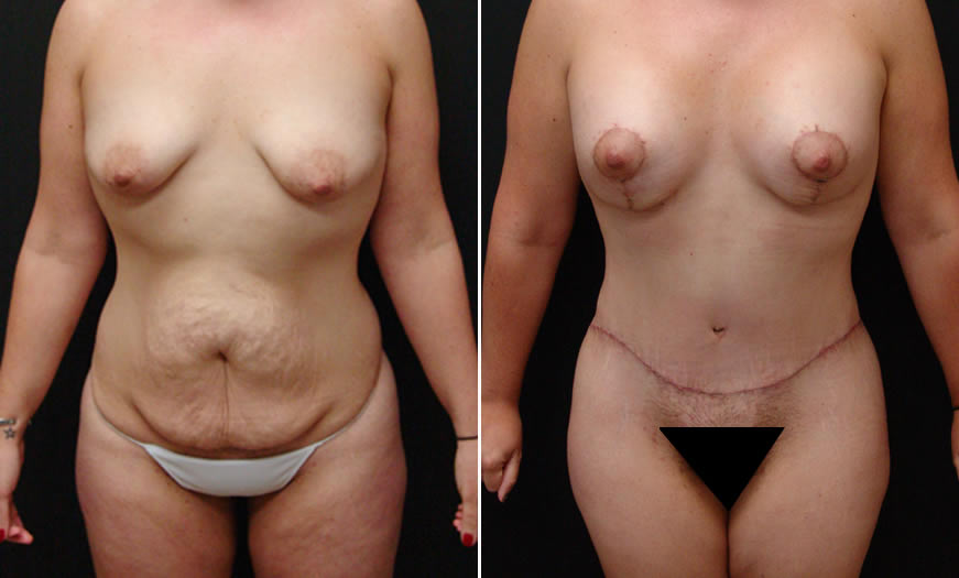 Before & After VASER LipoSelection Front View