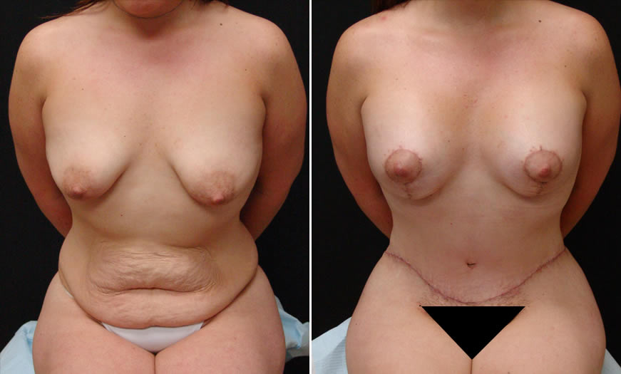 before & after VASER LipoSelection Front Sitting View