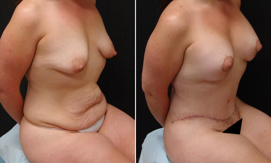 Before & After VASER LipoSelection Quarter Right Sitting View