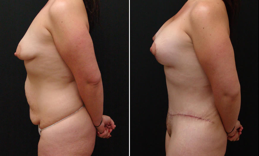 Before & After VASER LipoSelection Side Left View