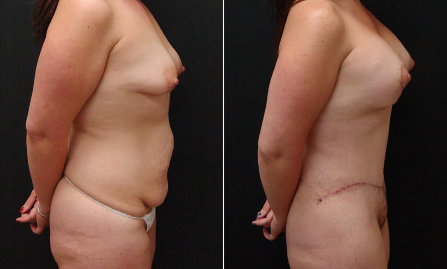 Before & After VASER LipoSelection Side Right View