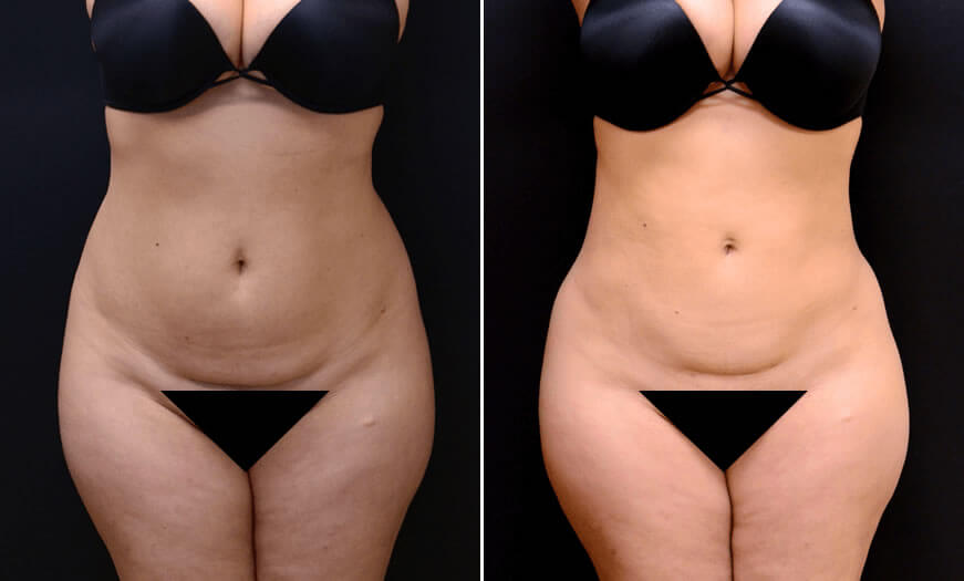 Before & After Liposuction Front View