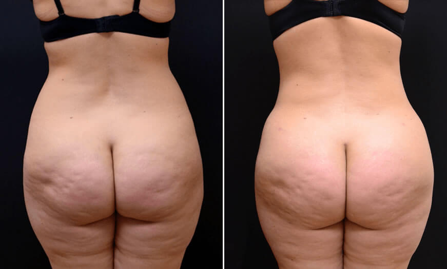 Before & After Liposuction Back View