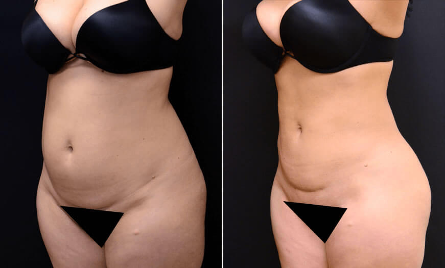 Before & After Liposuction Quarter Left View