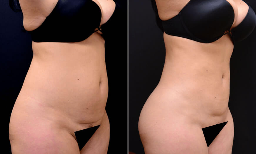 Before & After Liposuction Quarter Right View
