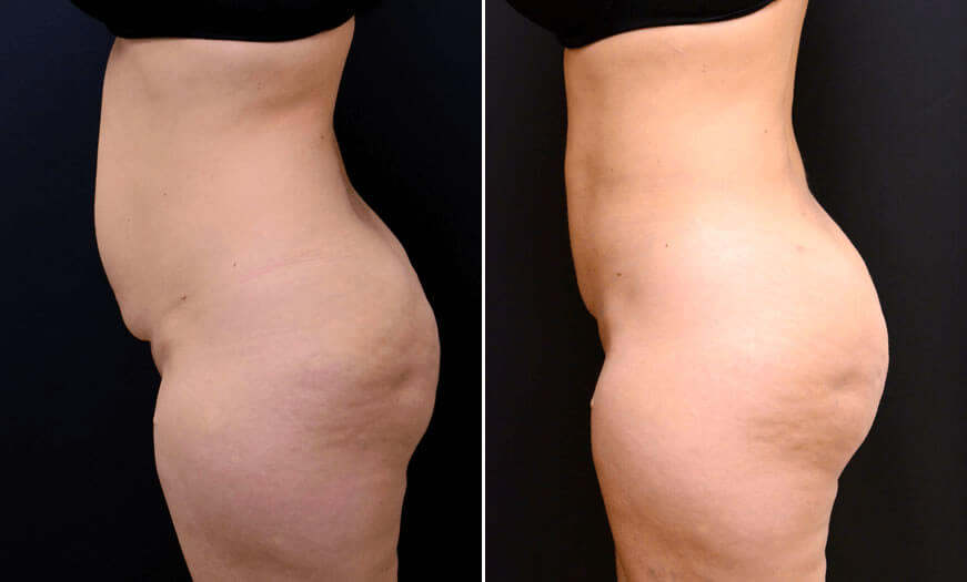 Before & After Liposuction Side Left View