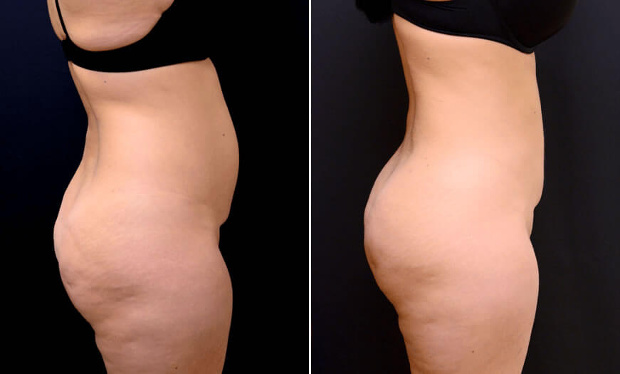 Before & After Liposuction Side Right View