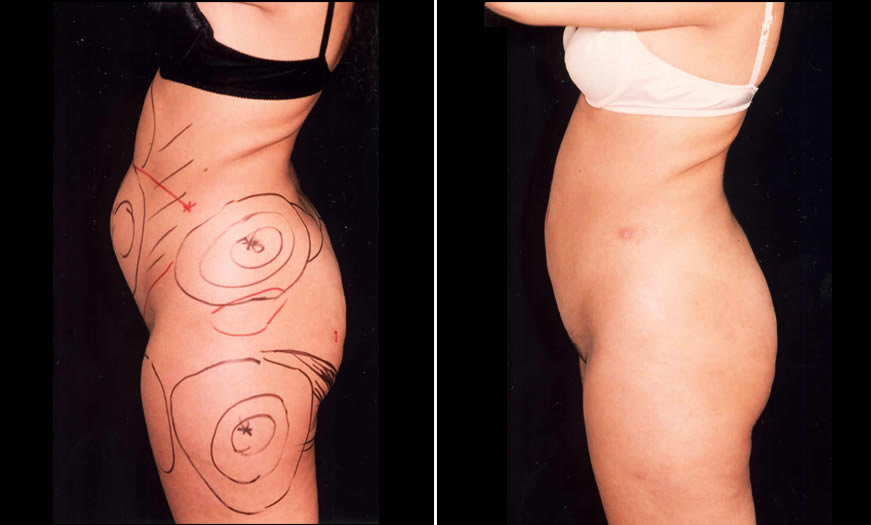 Before & After Liposuction Side Left View