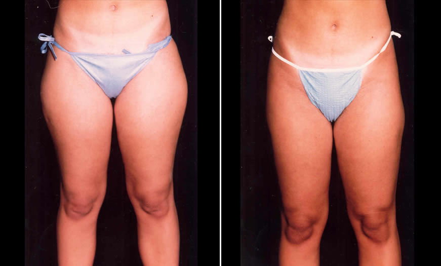 Before & After Liposuction Front View