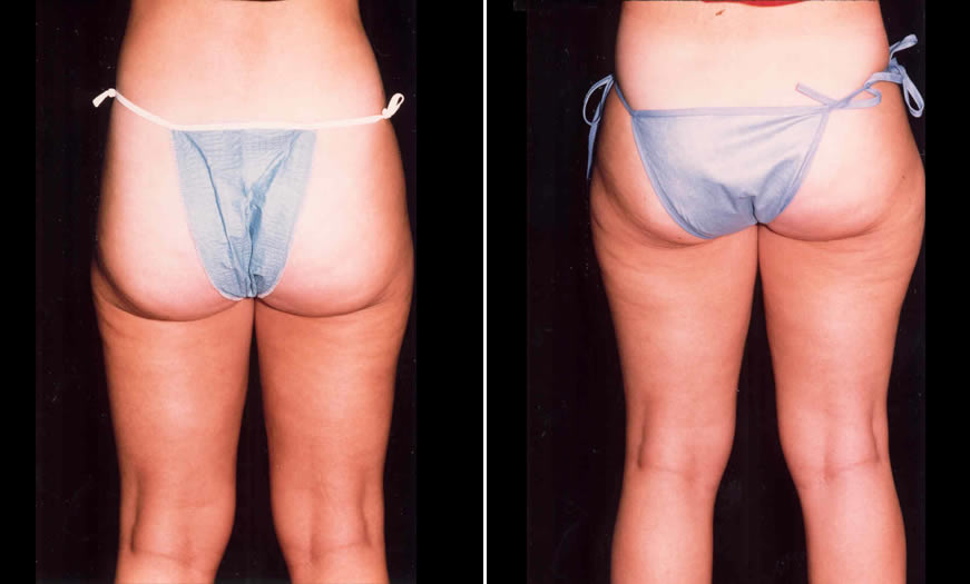 Before & After Liposuction Back View